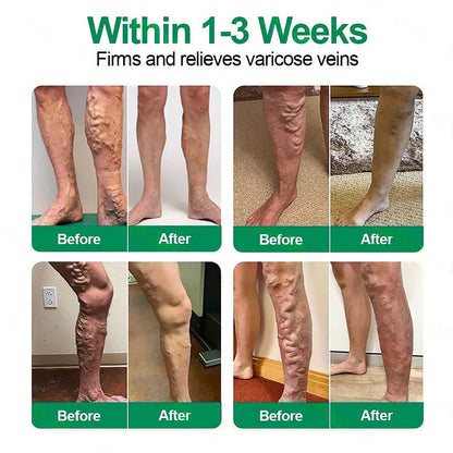 🇳🇿👨‍⚕️✅𝐇𝐞𝐚𝐥𝐫𝐢𝐳𝐞® VenoEase Soluble Microneedle Patch⚡Instant Relief, Long-Term Results ⚡