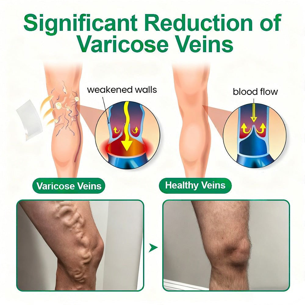 🇳🇿👨‍⚕️✅𝐇𝐞𝐚𝐥𝐫𝐢𝐳𝐞® VenoEase Soluble Microneedle Patch⚡Instant Relief, Long-Term Results ⚡